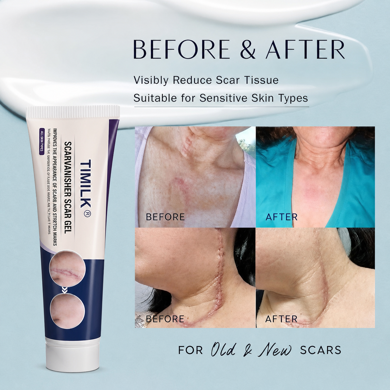 TIMILK Scar Vanisher Gel – Advanced Silicone Formula for Scars, Stretch Marks & Smooth Skin (Before & After Results)