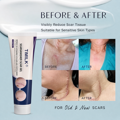 TIMILK Scar Vanisher Gel – Advanced Silicone Formula for Scars, Stretch Marks & Smooth Skin (Before & After Results)