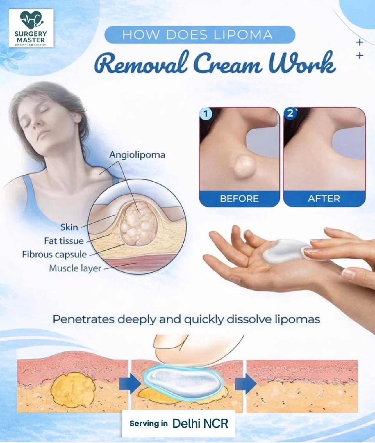 ✨ Buy 1 Lipoma Removal Cream and get 1 FREE