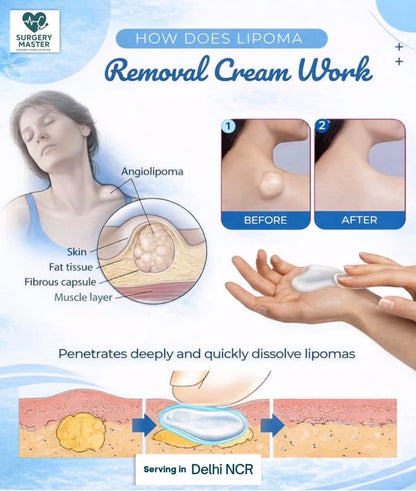 ✨ Buy 1 Lipoma Removal Cream and get 1 FREE